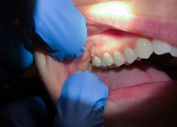 Best Emergency Treatment for Dental Infections or Abscesses in Vamo, FL