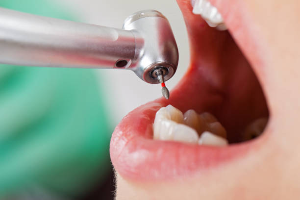 Best Emergency Wisdom Teeth Removal in Vamo, FL